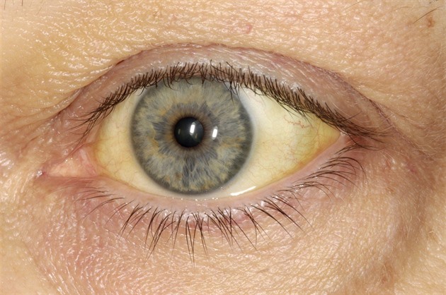 Už deset obětí žloutenky v Praze, po celém Česku je jich víc než dvojnásobek