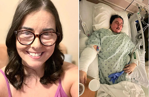 Alergická reakce na lék jako z hororu, žena málem nepřežila